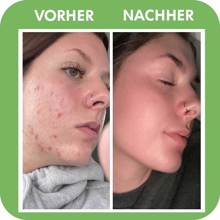 SKINCAR -  Poren Tiefenreinigungsmaske