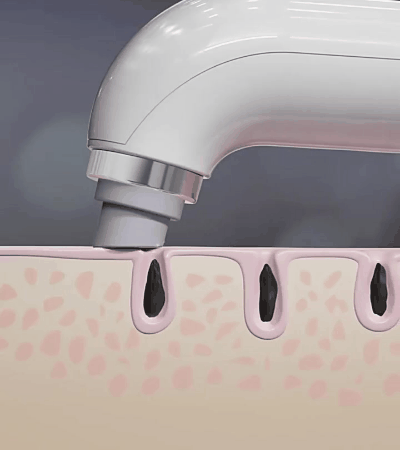 ClearFacial - Porenreiniger