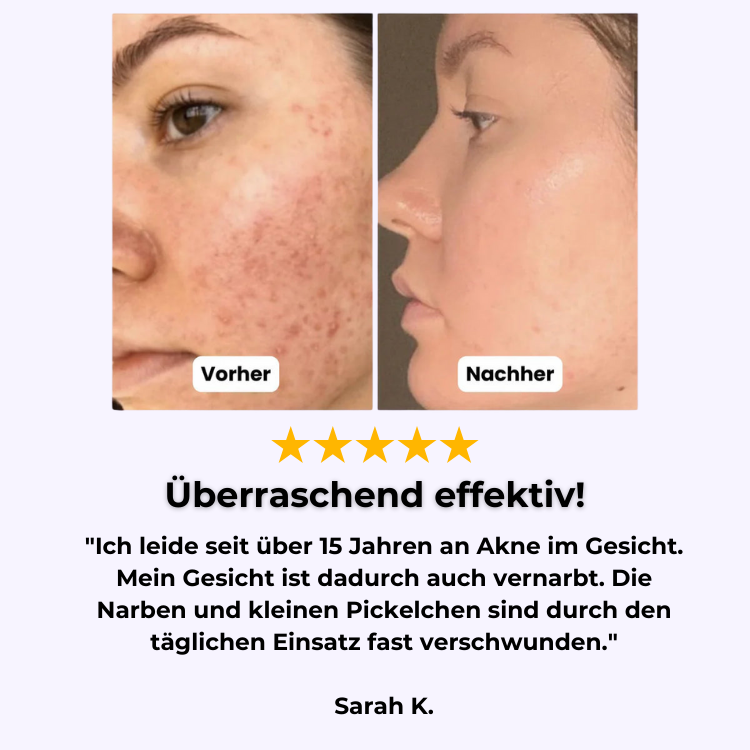 ClearFacial - Porenreiniger