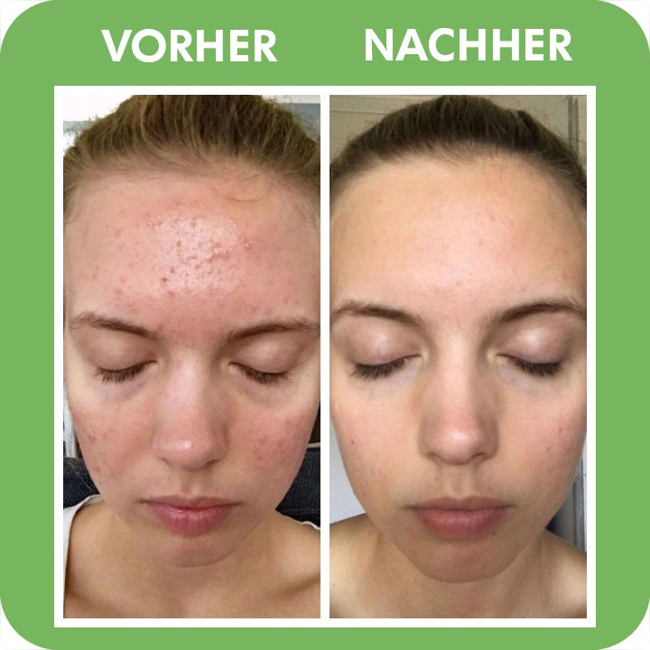 SKINCAR -  Poren Tiefenreinigungsmaske